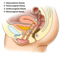 fistula